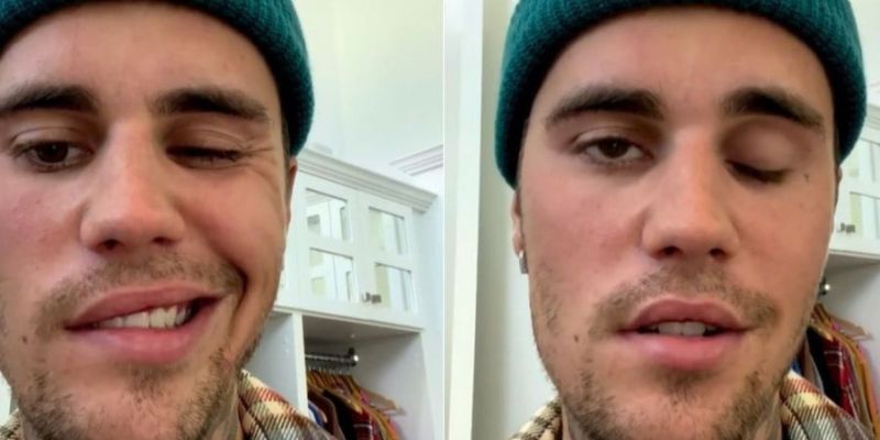 ¿Qué enfermedad le ha causado parálisis facial a Justin Bieber?